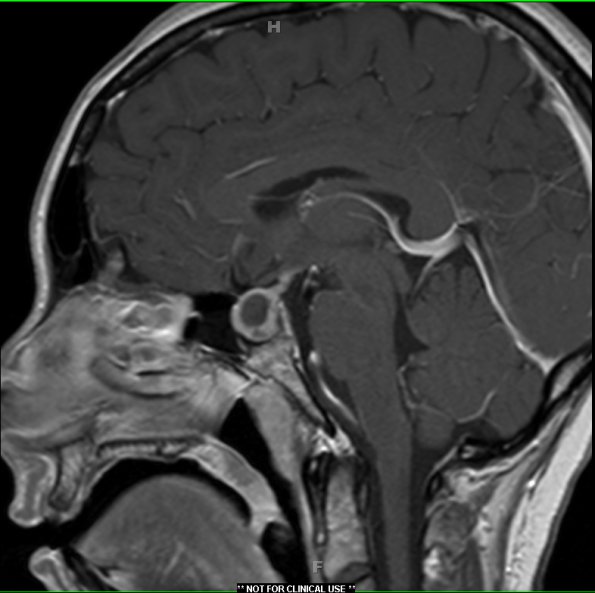 1A3 Granulomatous Hypophysitis (Case 1) T1 with contrast - Copy