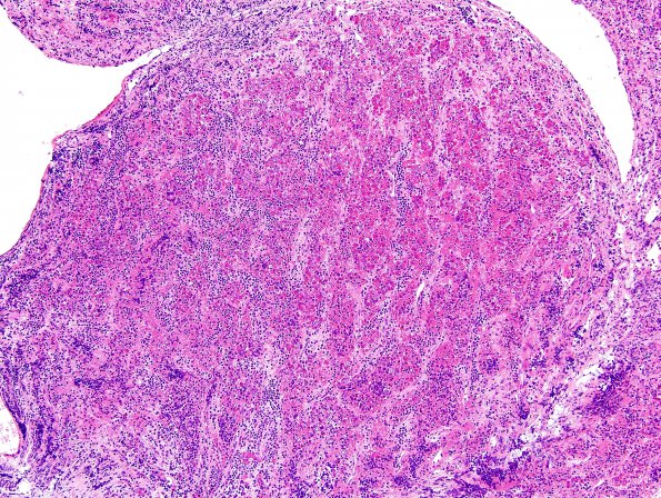 1B1 Hypophysitis, granulomatous (Case 1) area A H&E 1