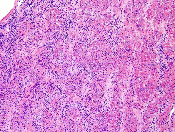 1B2 Hypophysitis, granulomatous (Case 1) area A H&E 2