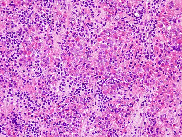 1B3 Hypophysitis, granulomatous (Case 1) area A H&E 3