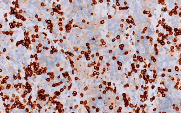 1C2 Hypophysitis, granulomatous (Case 1) CD3 1 (2)