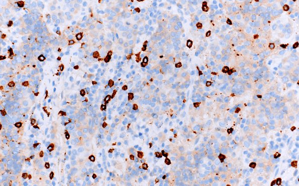 1D2 Hypophysitis, granulomatous (Case 1) CD20 1