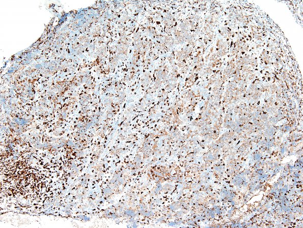 1E1 Hypophysitis, granulomatous (Case 1) area A CD163 3