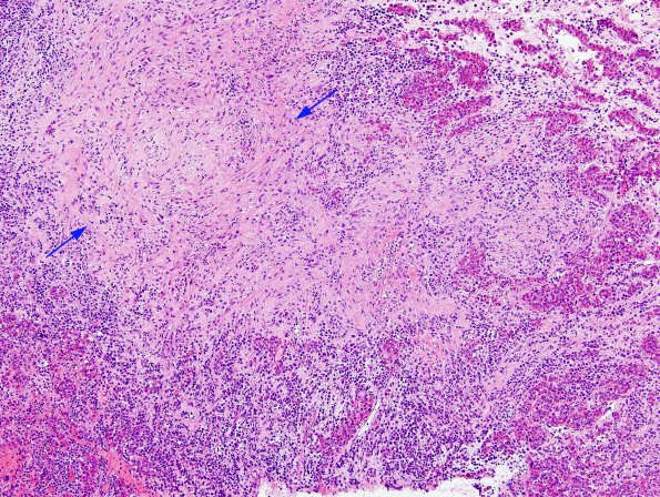 1F1 Hypophysitis, granulomatous (Case 1) H&E 1 copy