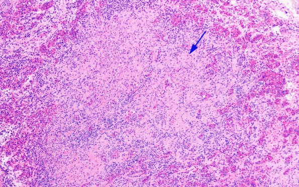 1F2 Hypophysitis, granulomatous (Case 1) H&E 7 copy