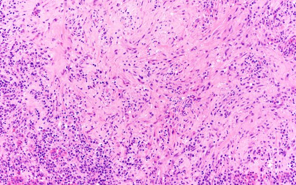 1F3 Hypophysitis, granulomatous (Case 1) H&E 2