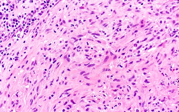 1F4 Hypophysitis, granulomatous (Case 1) H&E 4