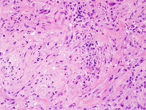 1F5 Hypophysitis, granulomatous (Case 1) H&E 7