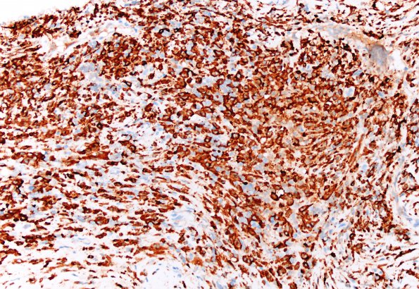 1G1 Hypophysitis, granulomatous (Case 1) CD163 3