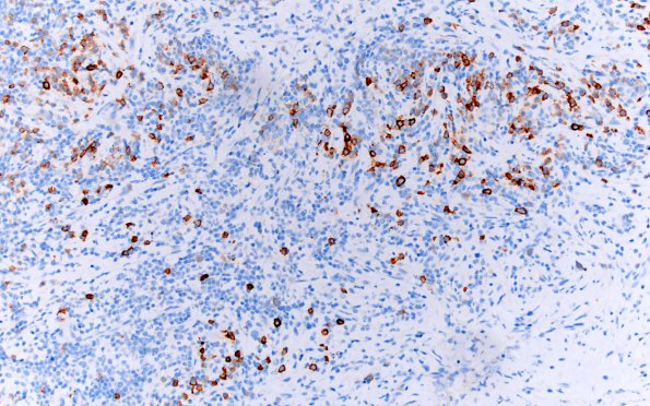 1H1 Hypophysitis, granulomatous (Case 1) area A CD138 1