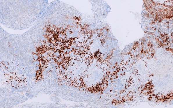 1H2 Hypophysitis, granulomatous (Case 1) PC rich area CD138 4X