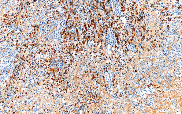 1I2 Hypophysitis, granulomatous (Case 1) PC rich area IgG 20X 1