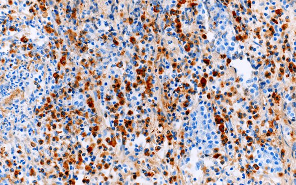 1I3 Hypophysitis, granulomatous (Case 1) PC rich area IgG 40X