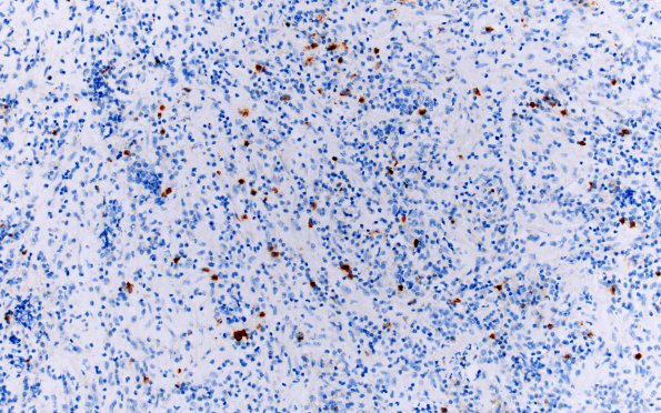 1I5 Hypophysitis, granulomatous (Case 1) PC rich area IgG4 20X 1