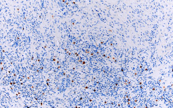 1I6 Hypophysitis, granulomatous (Case 1) PC rich area IgG4 20X 2