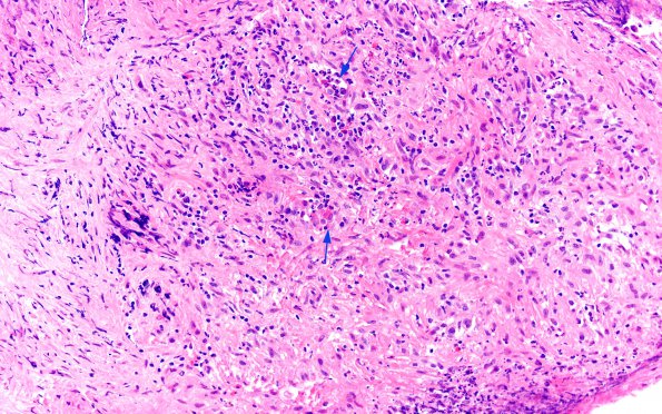 2A1 Hypophysitis, granulomatous (Case 2) H&E 8 copy