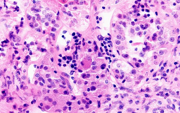 2A2 Hypophysitis, granulomatous (Case 2) H&E 12