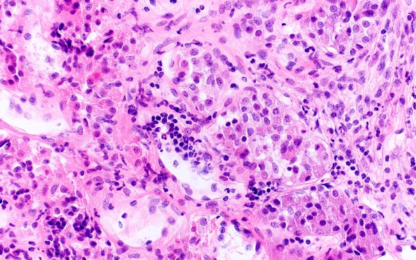 2A3 Hypophysitis, granulomatous (Case 2) H&E 11