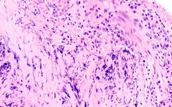 2A4 Hypophysitis, granulomatous (Case 2) H&E 6