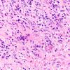 2A5 Hypophysitis, granulomatous (S96-8362) H&E 9