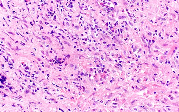 2A5 Hypophysitis, granulomatous (S96-8362) H&E 9