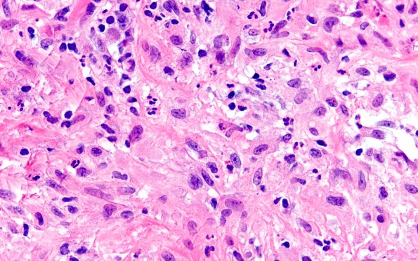 2A6 Hypophysitis, granulomatous (Case 2) H&E 13