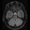 3A1 Necrotizing Granulomatous Hypophysitis (Case 3) FLAIR 1 - Copy