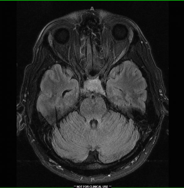 3A1 Necrotizing Granulomatous Hypophysitis (Case 3) FLAIR 1 - Copy