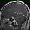 3A2 Necrotizing Granulomatous Hypophysitis (Case 3) T1 with contrast 2 - Copy copy