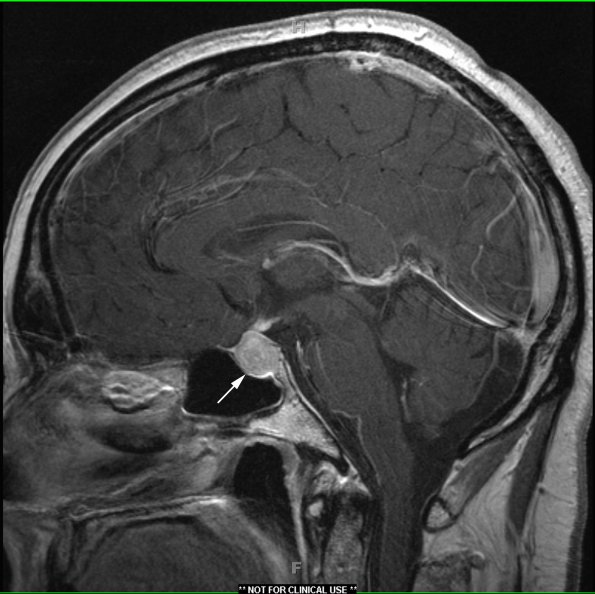 3A2 Necrotizing Granulomatous Hypophysitis (Case 3) T1 with contrast 2 - Copy copy