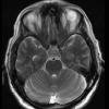 3A3 Necrotizing Granulomatous Hypophysitis (Case 3) T2 without contrast - Copy