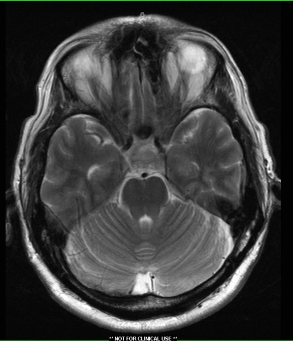 3A3 Necrotizing Granulomatous Hypophysitis (Case 3) T2 without contrast - Copy