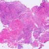 3B1 Hypophysitis, granulomatous-necrotizing (Case 3) H&E Whole mount 2