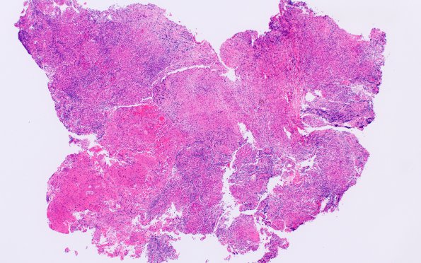 3B1 Hypophysitis, granulomatous-necrotizing (Case 3) H&E Whole mount 2