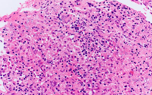 3B2 Hypophysitis, granulomatous-necrotizing (Case 3) H&E 2