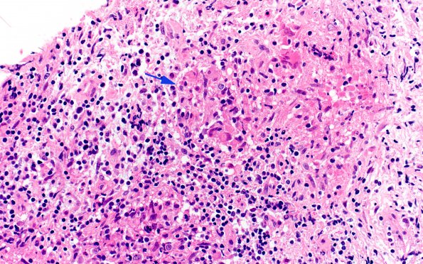 3B3 Hypophysitis, granulomatous-necrotizing (Case 3) H&E 4 copy