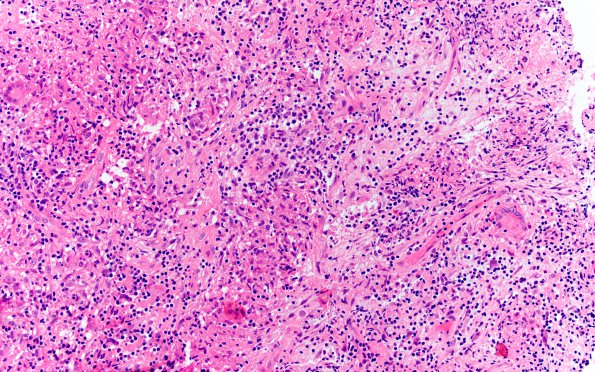 3B4 Hypophysitis, granulomatous-necrotizing (Case 3) H&E 8