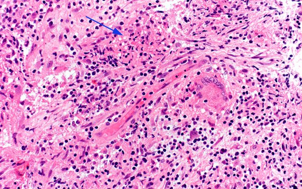 3B5 Hypophysitis, granulomatous-necrotizing (Case 3 H&E 9 copy