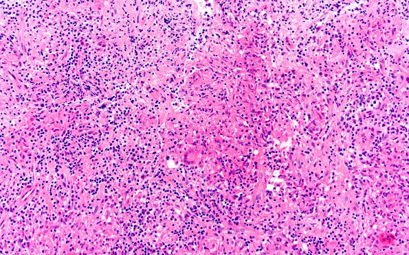 3B6 Hypophysitis, granulomatous-necrotizing (Case 3) H&E 10