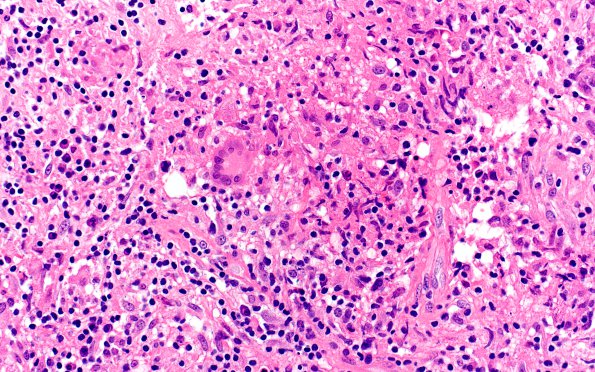 3B7 Hypophysitis, granulomatous-necrotizing (Case 3) H&E 11