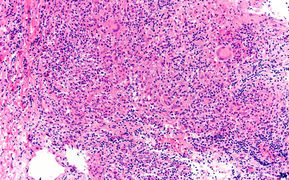 3B8 Hypophysitis, granulomatous-necrotizing (Case 3) H&E 14