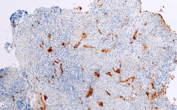 3C1 Hypophysitis, granulomatous-necrotizing (Case 3) Synaptophysin 3A