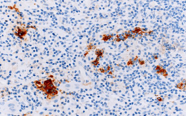 3C2 Hypophysitis, granulomatous-necrotizing (Case 3) Synaptophysin 1