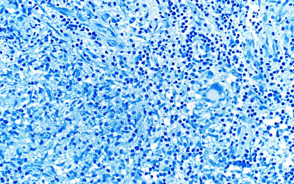 3D Hypophysitis, granulomatous-necrotizing (Case 3) AFB negative