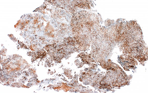 3E1 Hypophysitis, granulomatous-necrotizing (Case 3) CD3 4