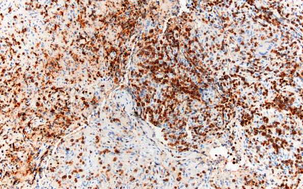 3E3 Hypophysitis, granulomatous-necrotizing (Case 3) CD3 1