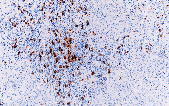 3F Hypophysitis, granulomatous-necrotizing (Case 3) CD20 1