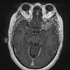 4A1 Granulomatous Hypophysitis (Case 4) T1W meningioma