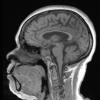 4A2 Granulomatous Hypophysitis (Case 4) FL2D noC