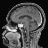 4A3 Granulomatous Hypophysitis (Case 4) FL2D W